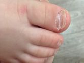 Слоятся ногти у ребёнка