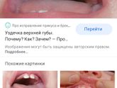 Девочки,заметила у ребёнка уздечка
