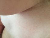 Подскажите, это аллергия или