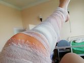 Флэбэктомия! Кому делали.
