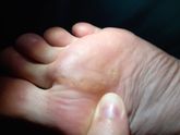 Больно наступать на ступню,?