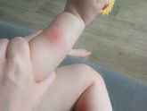 Укусы насекомых