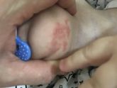 Аллергия или что?