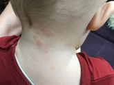 Пятна шершавые в одном месте