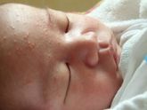 Аллергия что делать помогите