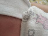 Моей доче 10 дней, а у неё на лице появились вот такие пятна 3 штуки, я очень переживаю что это??? Фото в комментариях ((((