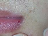 Красное пятно на губе