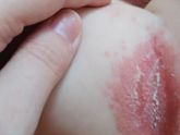 Сильные опрелости между ляшечкой