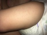 Сыпь