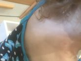 Укусы? Или начало ветрянки?