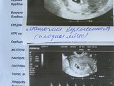 Сходила на УЗИ
