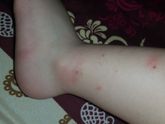 Кто укусил?