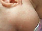 Потница или аллергия? Help