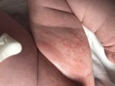 Аллергия или от жары?