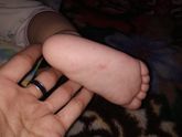 Красные пятнышки на пятке