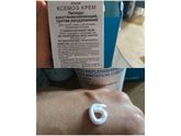 Опрелости