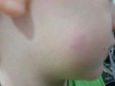 Девочки это лишай?