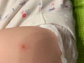 Что это ?укусы или прыщи ?