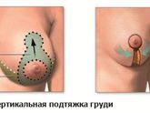 Пластика груди и лазерная шлифовка шрамов