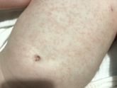 Аллергия или краснуха ?