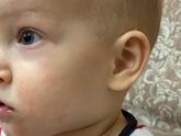На что похожа сыпь?