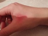 Раздражение на руке. Чем можно вылечить?