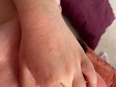 Сыпь на руках у сына