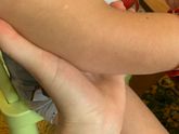 Белые пятнышки на коже у ребёнка.