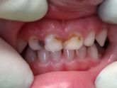 Лечение передних молочных зубов