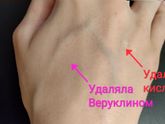 Про удаление бородавок. Мой личный метод проб и ошибок.