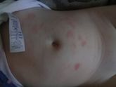 Помогите советом. Сыпь