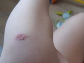 Вот мозоль...банеоцином