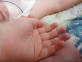 Облезает кожа на пальцах!