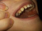 Может быть пульпит второй раз у ребенка или почему болит зуб