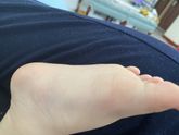 Подскажите пожалуйста есть ли плоскостопие ?