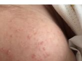 Вот цветение в 2 недели после родов и то что стало сейча поры расширены