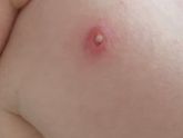 Место прививки на плече . Должно так выглядеть ?