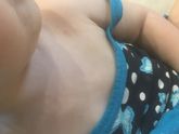Укусы? Или начало ветрянки?