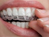 Закрепление зубов после снятия брекет- системы
