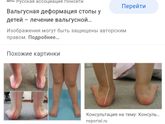 Плоско-Вальгусная деформация стоп(х-образная установка),