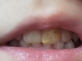 Коронки на зубы у