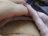 Девочки,у кого было кесарево!!!