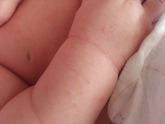 Цветение или акне?