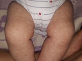 Сыпь