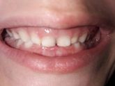 Проблема с зубами, не правильный прикус, мало места постоянным зубам