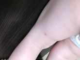 Красные как прыщики