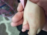 Высыпания на руке