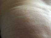 На попе пятна , бесцветные и шелушатся. Что это может быть ?