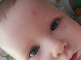 Чем помазать прыщик?