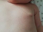 Это потничка или аллергия?